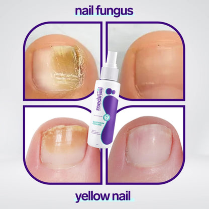 Jaysuing® - Magic Nail Fungus Spray